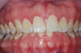 27 year old patient with gingivitis