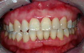A. Reddish gums at the junction between the teeth and the gums. Note the black deposits (tartar) between the teeth.