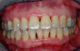 B. Pink and healthy gums