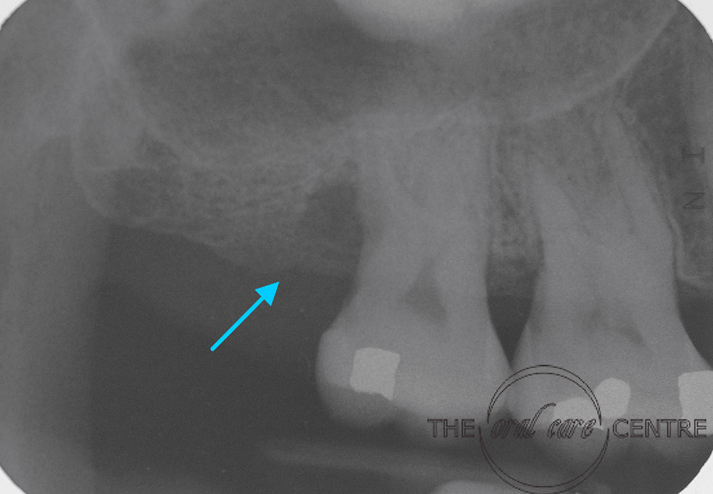  Pre-Op X-ray showing bony defect