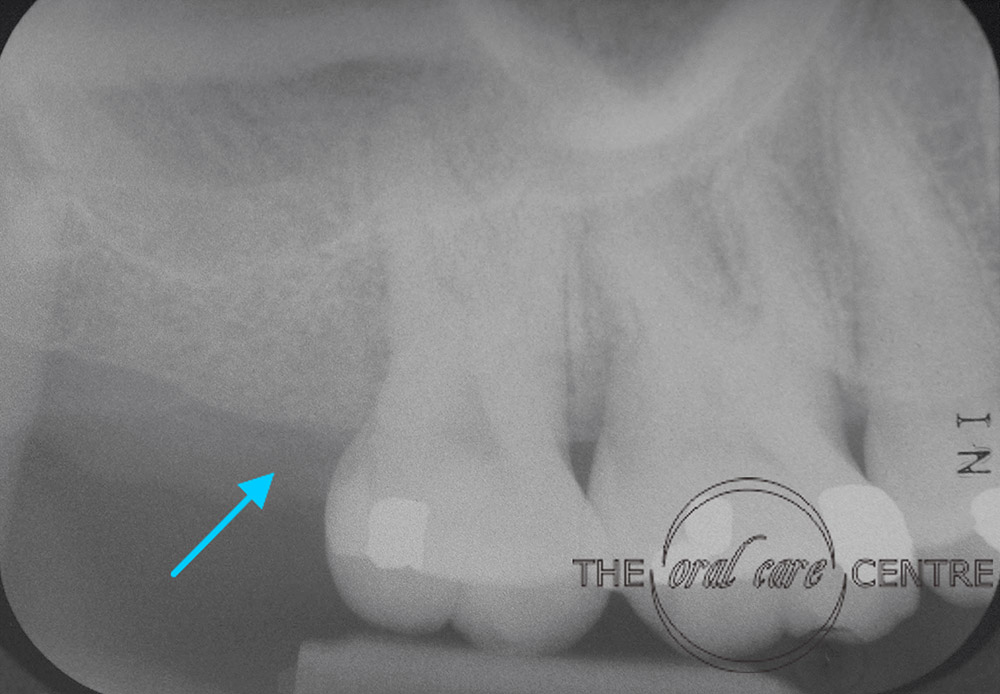Post-Op X-ray showing bone fill